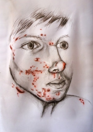 Ein Junge mit Pickeln im gesicht.